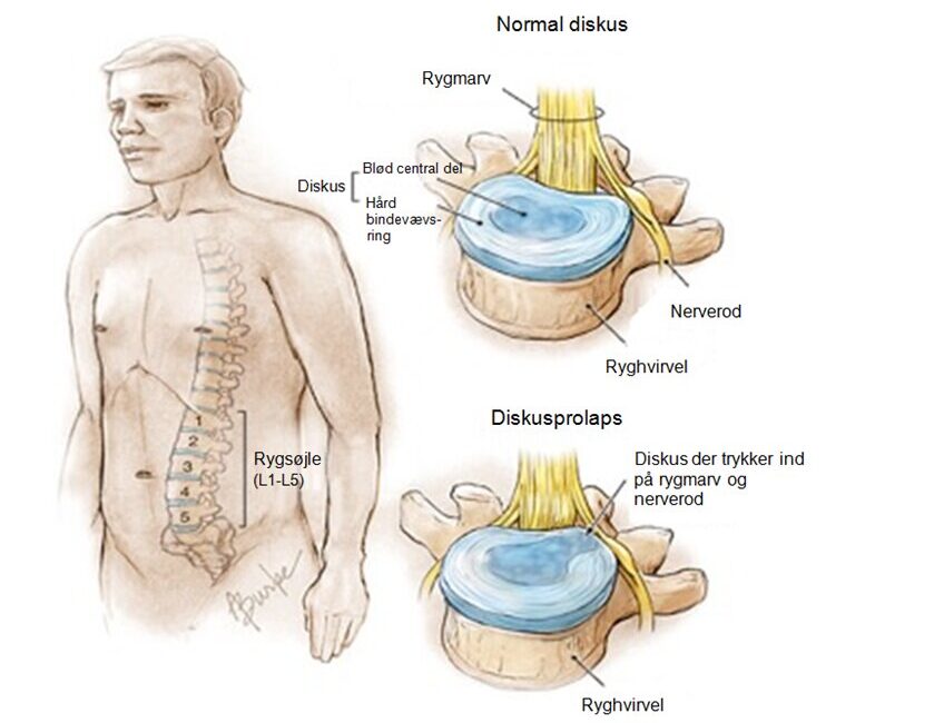 Disc herniation | Treatment of chronic back pain with gold