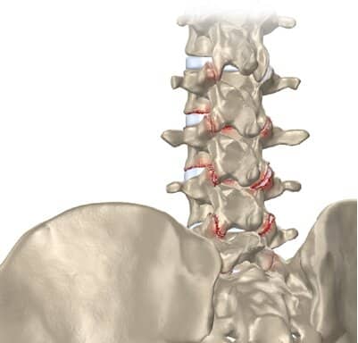 Slidgigt i ryggen - Gold implant clinic