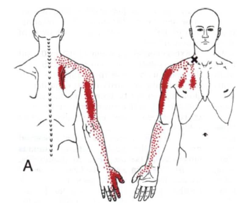 udstrålende smerter arm som følge af piskesmæld (Whiplash syndrom)